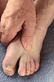 Image result for diabetic toes