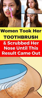 It will make your nose sharper and smaller in some days. Toothpaste On Nose Toothpaste On Nose Before And After How Does Toothpaste Make Your Nose Smaller How To Remove Blackhea Health Brushing Teeth Skin Problems