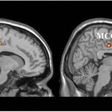 Pdf Idiopathic And Acquired Pedophilia As Two Distinct Disorders An Insight From Neuroimaging