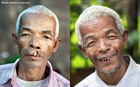 After 50 years living with a cleft lip, Alfred never expected his life to  change