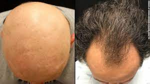 Jangan biarkan rambut yang rontok berlebihan menimpa anda. Pil Putih Ini Obat Mujarab Penumbuh Rambut Di Kepala Botak Global Liputan6 Com