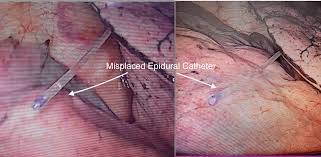Image result for Intrapleural Anesthesia