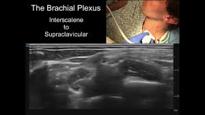 Image result for Superior Trunk Block