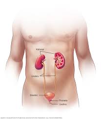 حصوات في الكلى الأعراض والأسباب mayo clinic مايو كلينك
