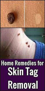 Type Of Skin Moles Healthy Medicine Tips Home Remedies For Skin Skin Tag Removal Skin Moles