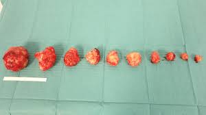 We did not find results for: Myomectomie