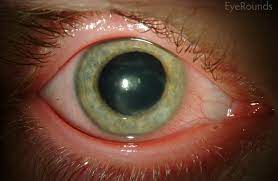 Introduction disease definition herpes simplex virus (hsv) keratitis is an infectious disease of the cornea. Herpes Simplex Keratitis