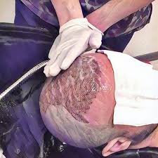 Hair Transplant in Turkey
