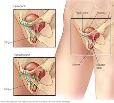 Pin On Bladder