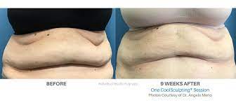 We're spilling all the details: Coolsculpting Before And After Coolsculpting New Jersey