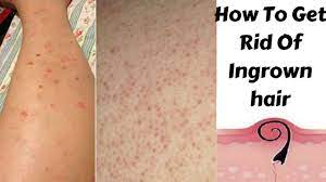 Since genital warts require treatment and are contagious, a gynecologist should make the distinction for you. Subscribe For More Such Videos Ingrown Hair Are Those Hair That Have Curled Up And Grown Ba Ingrown Hair Remedies Ingrown Hair Removal Ingrown Hair