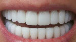 El Rey Sin Dientes Perfect Teeth White Teeth Cosmetic Dentistry