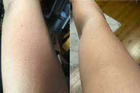 Scrub but not much hard keratosis pilaris bumps are hardened dead skin and so to get rid of them you need to exfoliate to remove that dead skin. How I Got Rid Of The Bumps On My Upper Arms Ameliorate