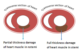Compared to the more common type of heart attack known as stemi, an nstemi is typically. Nstemi Vs Stemi How To Relieve Stress Acls Study Guide Cardiac Catheterization