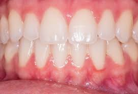 Take care of your mouth so you can avoid gum disease and the unpleasant symptoms that go with it. Healthy Gums Archives Defacto Dentists