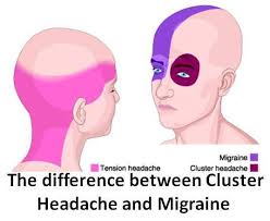 Cluster Headache Vs Migraine Cluster Headaches Migraine Vs Headache Headache Symptoms