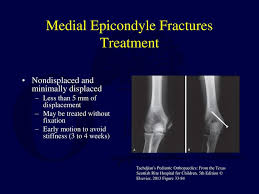Learn about epicondyle of humerus with free interactive flashcards. Fractures And Dislocations About The Elbow In The Pediatric Patient Ppt Download