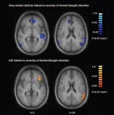 Anatomia lui grey ne introduce in viata de zi cu zi a echipei de stagiari si a indrumatorilor acestora din spitalul seattle grace. Structural And Metabolic Changes In Language Areas Linked To Formal Thought Disorder The British Journal Of Psychiatry Cambridge Core