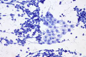 Rbc, wbc, red cells casts 2. Un Nas Electronic Poate Detecta PacienÈii Care Nu RÄspund La Imunoterapia Pentru Cancer Pulmonar 360medical Ro