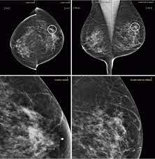The look of breast cancer on a mammogram a tumor or lump will appear as a focused white area on the mammogram. Ai Tool Improves Breast Cancer Detection On Mammography Imaging Technology News
