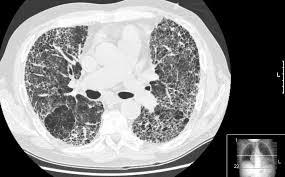 The cancer develops when abnormal cells crowd out healthy ones, potentially causing a lump in the breast or a bloody discharge from the nipples. High Resolution Computed Tomography Wikipedia