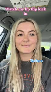 Finally got a lip flip! #lipflip #lipflipresults #botox #botoxinjection