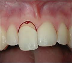 Image result for Tooth Luxation