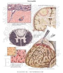 Image result for Neurosyphilis