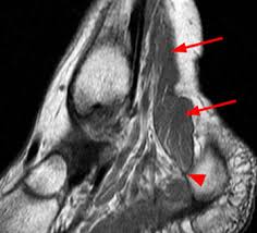 We did not find results for: Accessory Muscles Of The Ankle Radsource