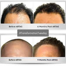 Before And After Artas Hair Transplant Hair Restoration Hair Transplant Hair Transplant Surgery