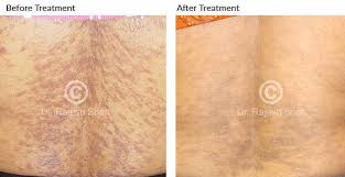 Homeopathic Treatment For Lichen Planus Lichen Planus Cure And Treatment Options