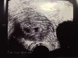 Und ich denke, das man heutzutage zwillinge frühzeitig erkennen würde. Zwillinge Dezember 2014 Babyclub Babycenter
