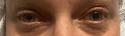 Image result for Mydriasis