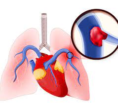 Simptomele tipice ale emboliei pulmonare constau în: Embolism Pulmonar Cauze Tratament Metode De Prevenire Primele Semne De Embolie PulmonarÄƒ