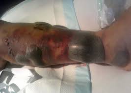 Check spelling or type a new query. Necrotizing Fasciitis Synergistic Necrotizing Cellulitis Fournier S Gangrene Hemolytic Streptococcal Gangrene Meleney S Ulcer Suppurative Fasciitis Ludwig S Angina Dermatology Advisor