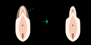 副皮・クリトリス包茎術 | モデナクリニック｜福岡天神の美容外科・美容皮膚科