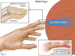 Jammed Finger Treatment The Recovery Doc Dr Rick Rosa Jammed Finger Finger Injury Hand Injuries