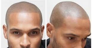 Men Have Found A Unique Solution To Hiding Male Pattern Baldness Hair Loss Men Male Pattern Baldness Thining Hair