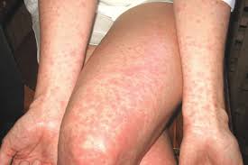 La scarlattina può manifestarsi con diversi sintomi più o meno lievi, ma sono alcuni che, più di altri, indicano che siamo proprio di fronte a questa malattia esantematica.ad interessare tutti, neonati, bambini, ma anche adulti, è un malassere generale (stesso sintomo di morbillo e rosolia), che si manifesta attraverso spossatezza, mal di gola (causato da tonsille gonfie e presenza di pus. Scarlattina Cos E Cause E Sintomi Consiglibenessere Org