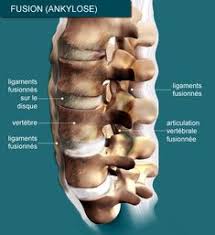 Самые новые твиты от spondylarthrite ankylosante (@spondylite): Spondylarthrite Ankylosante