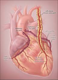 Bypass synonyms, bypass pronunciation, bypass translation, english dictionary definition of bypass. Coronary Artery Bypass Grafting Nejm