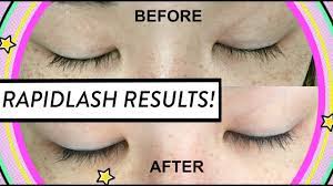 Table of contents1 product review2 before and after comparison3 pros4 cons5 summary rapidlash eyelash enhancing serum doesn't contain the same active ingredient as latisse, so it's available without any medical prescriptions. Rapid Lash Review Results Before After Hellohannahcho Youtube