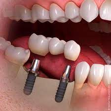 Zahnbrucke Aus Vollkeramik Zahnbrucke Kosten Zahnbrucke Oder Implantat Dentalreisenpolen