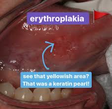 Image result for Erythroplakia roof of mouth
