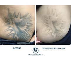 Melanie palm at 858.792.skin (7546) to schedule your appointment. San Diego Laser Tattoo Removal Clinic Home Facebook