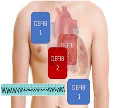 Manual internal defibrillators deliver the shock through paddles placed directly on the heart.1 they are mostly used in the. Defibrillation Article