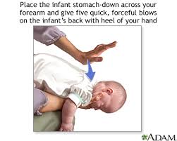 choking first aid infant under 1 year series part 1 medlineplus medical encyclopedia choking first aid infant under 1 year