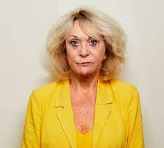 But things have changed now! Sherrie Hewson Facelift Loose Women Star Shows Off Facelift Results Fat Transfer Express Co Uk