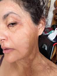 Burn Bulletin Archives