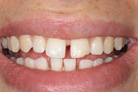 When you smile, do you see a gap between your teeth? Gap Between Your Teeth Let Orthodontics Straighten That Out